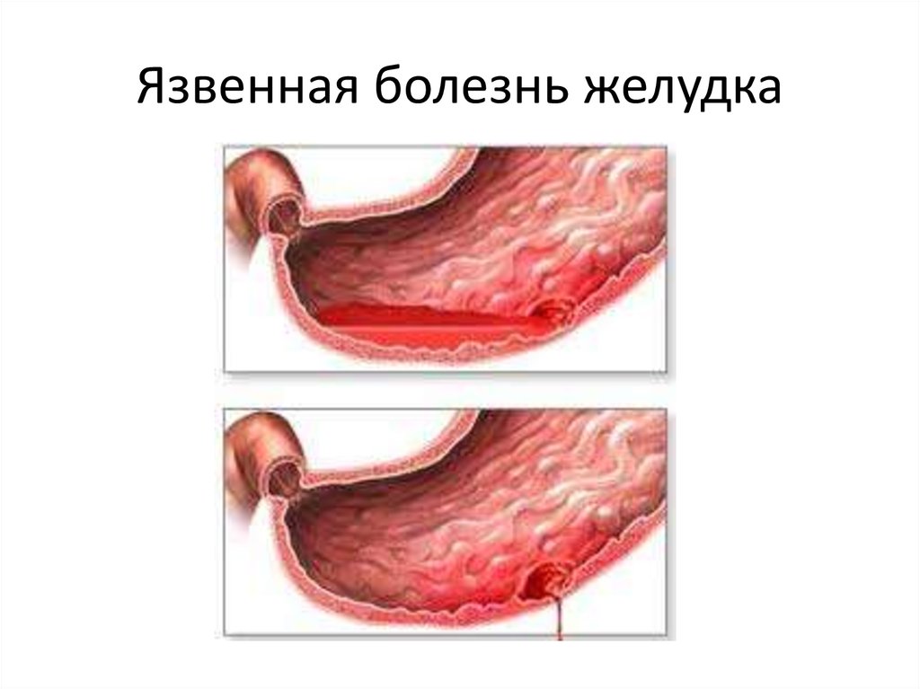 Язвенная болезнь желудка рисунок