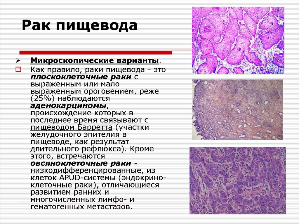 Рак пищевода и желудка презентация