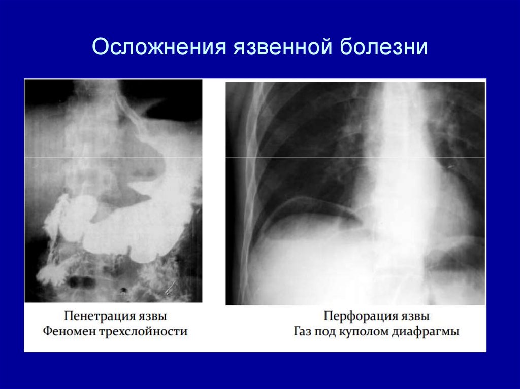 Осложнения желудка 12 перстной кишки. Рентген пенетрирующая язва ДПК. Перфоративная язва желудка осложненная. Перфорация язвы желудка рентген схема. Перфорация гастродуоденальной язвы на рентгене.