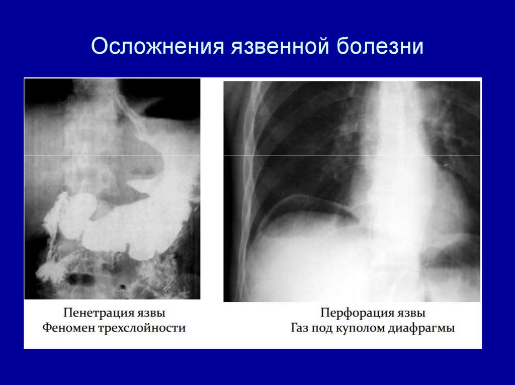 Язвенная болезнь осложнения. Перфоративная язва желудка осложнения. Перфоративная язва желудка рентген. Перфорация язвы желудка рентгенограмма. Пенетрация 12 перстной кишки.