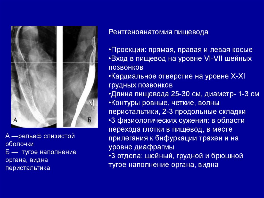 1 3 пищевода. Рентгеноскопия пищевода норма. Анатомия пищевода рентген. Сужение пищевода рентген.