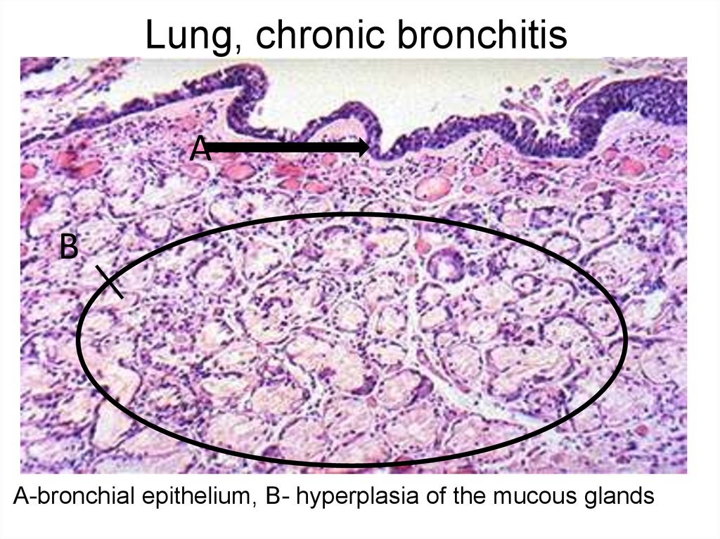 pathological changes in bronchial asthma
