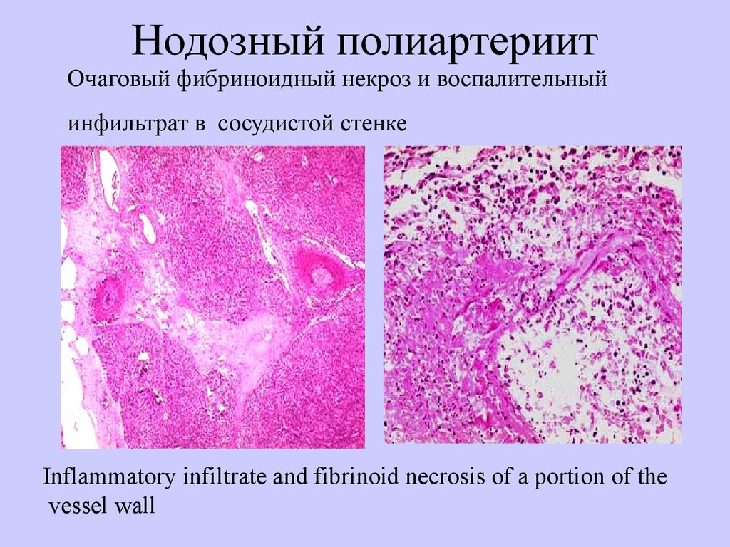 Васкулиты патанатомия презентация