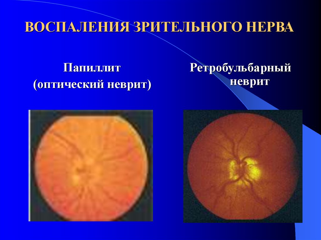 Лечение глазного нерва. Оптический неврит папиллит. Ретробульбарный неврит (папиллит). Папиллит диска зрительного нерва. Ретробульбарный неврит зрительного нерва.