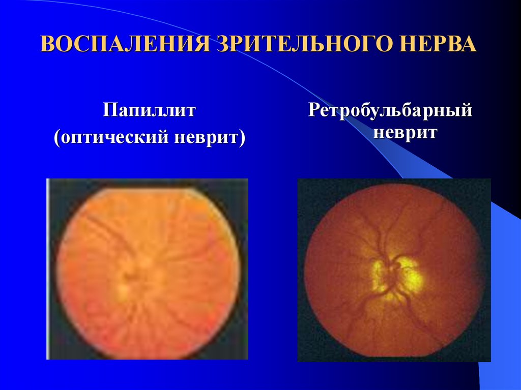 Неврит зрительного нерва. Неврит зрительного нерва (папиллит). Ретробульбарные невриты зрительного нерва. Ретробульбарный неврит (папиллит). Папиллит (оптический неврит).