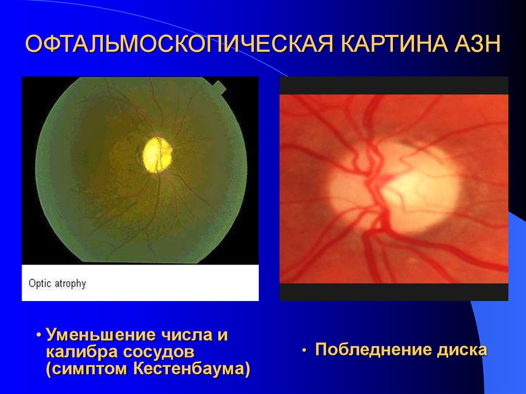 Поражение зрительного. Побледнение дисков зрительного нерва. Клинические проявления поражения зрительного нерва. Симптом Кестенбаума в офтальмологии. Заболевания диска зрительного нерва.