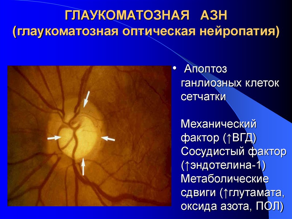 Нейропатия зрительных. Глаукомная нейропатия зрительного нерва. Оптическая нейропатия зрительного нерва. Ишемическая нейрооптикопатия зрительного нерва. Задняя ишемическая оптическая нейропатия.