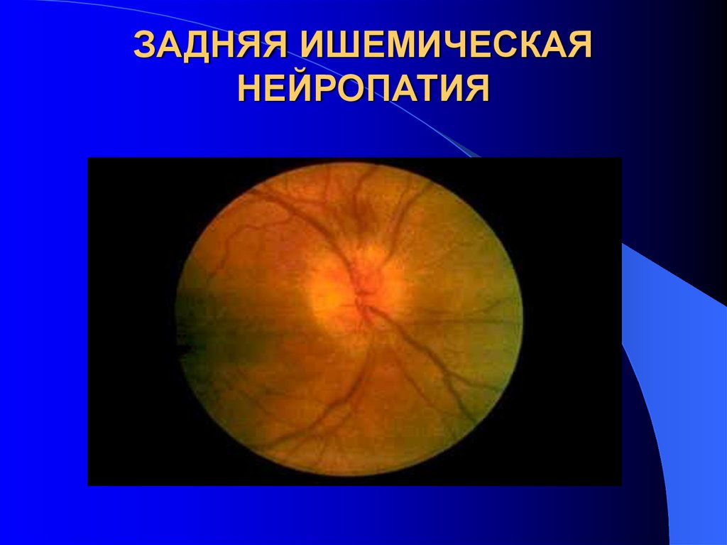 Передняя ишемическая нейропатия. Ишемическая нейропатия глазное дно. Передняя ишемическая оптиконейропатия зрительный нерв. Ишемическая оптикопатия зрительного нерва. Задняя ишемическая нейропатия зрительного нерва.