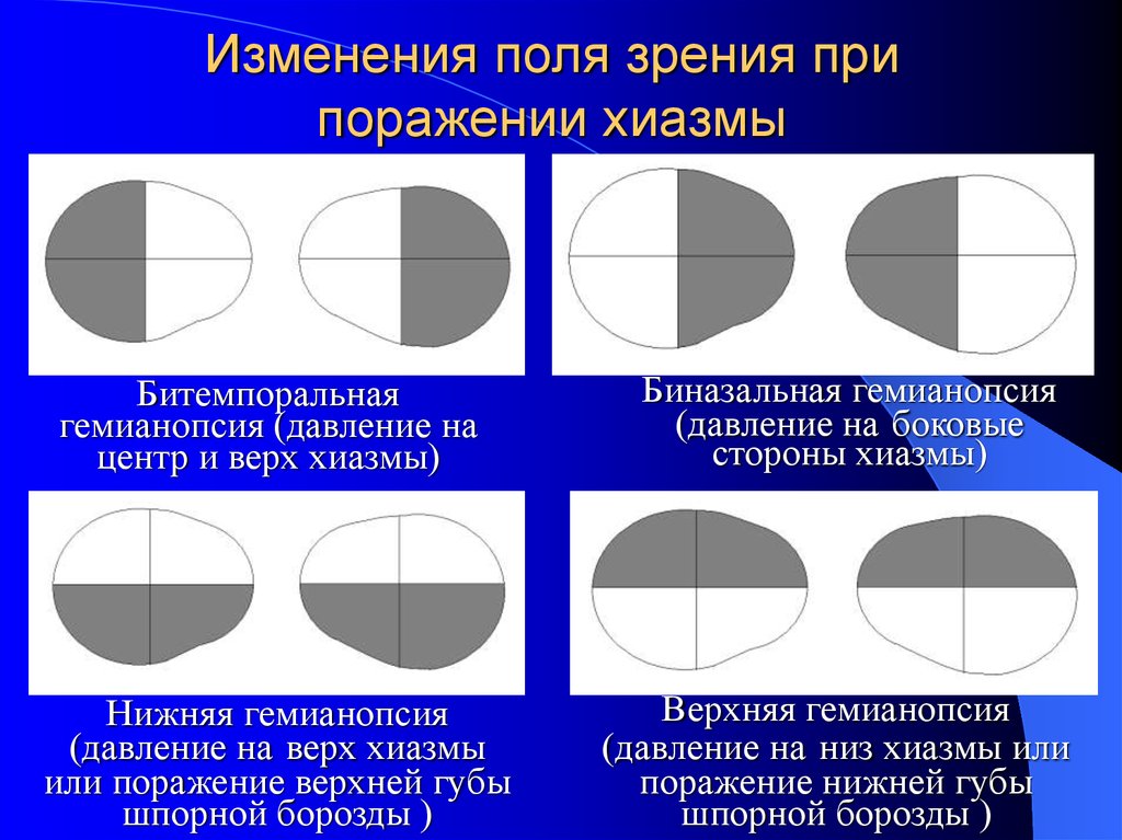 Поражение зрительного. Гетеронимная битемпоральная гемианопсия. Гомонимная гемианопсия поля зрения. Выпадение полей зрения. Назальная гемианопсия.