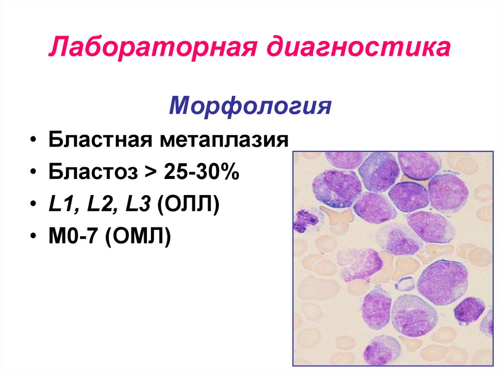 Острый лимфобластный лейкоз презентация