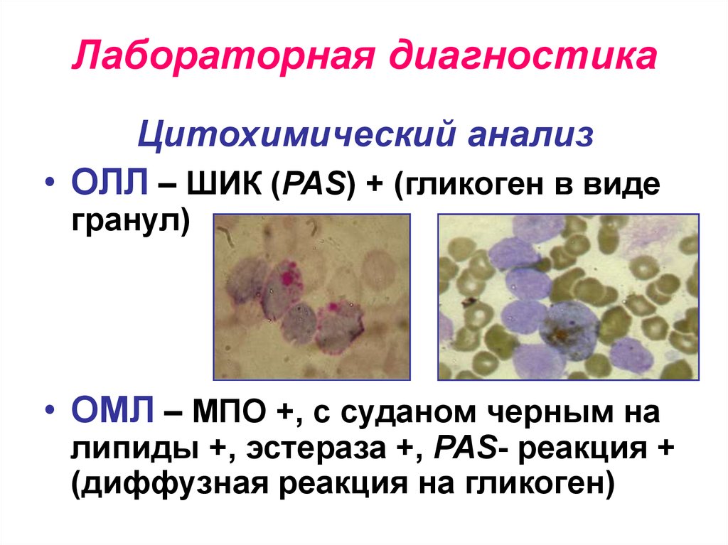 Реакция на лейкоциты положительная. Остром монобластный лейкоз цитохимическая реакция. Острый лимфобластный лейкоз Шик реакция. Острый миелобластный лейкоз гликоген. Острый миелобластный лейкоз цитохимическая реакция.