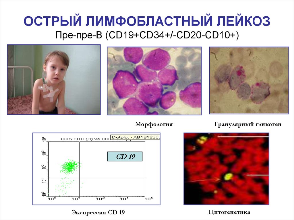 Лейкоз у детей презентация