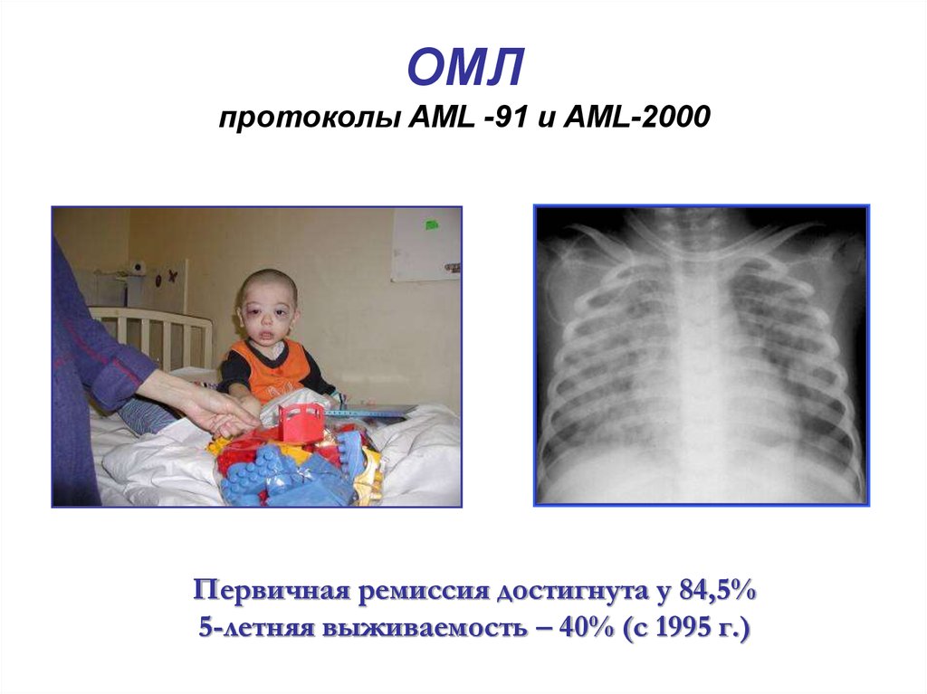 Лечение миелобластного лейкоза. Острый миелобластный лейкоз. Острый миелобластный лейкоз протокол. Острый миелоидный Лейко. Острый миелобластный лейкоз у детей.