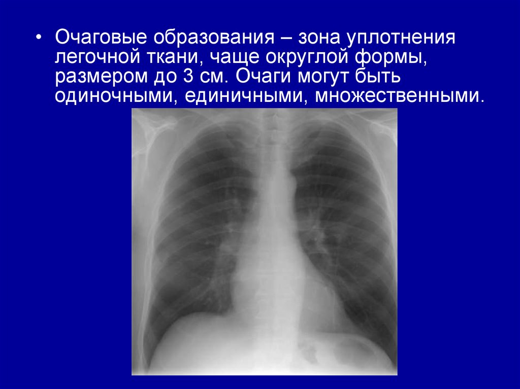 Очаговые изменения в легких презентация