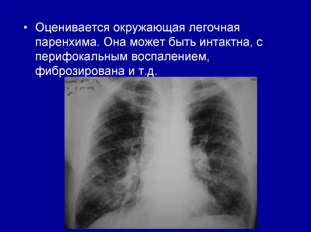 Очаговое образование в правом легком. Легочная паренхима. Перифокальное воспаление в легком это. Очаговые образования в легких.