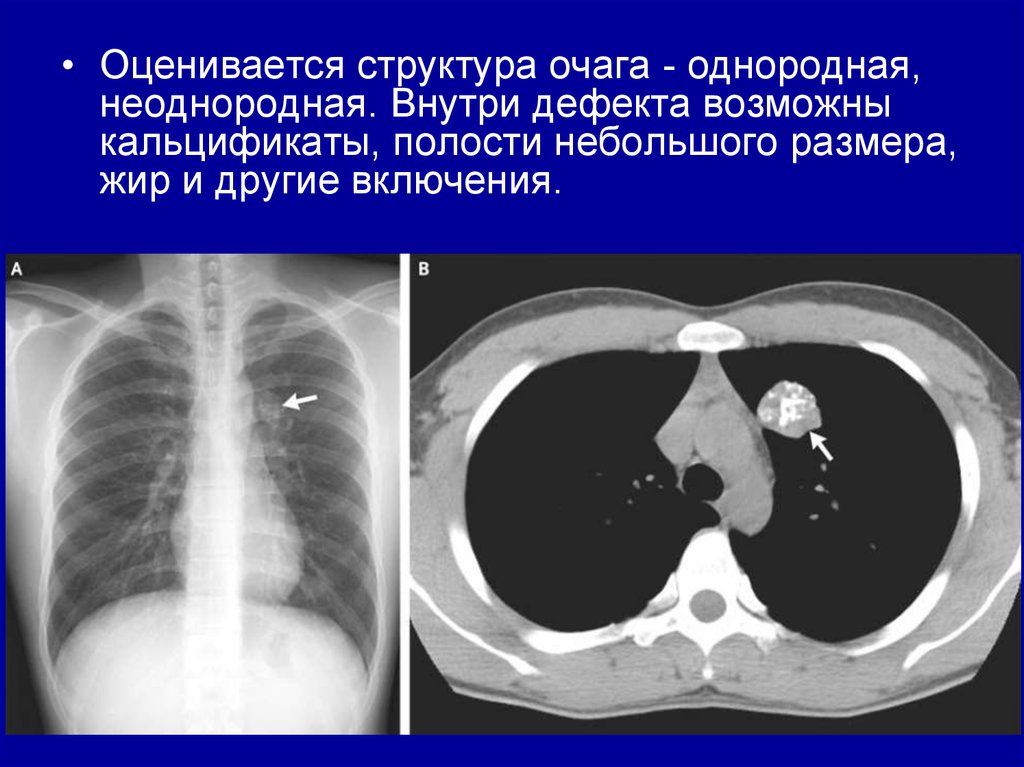 Доброкачественные опухоли легких презентация