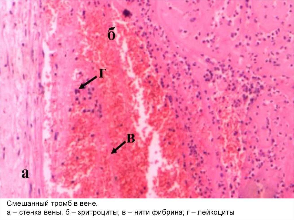Тромб микропрепарат. Красный обтурирующий тромб микропрепарат. Смешанный тромб в Вене микропрепарат. Смешанный тромб артерии микропрепарат. Пристеночный тромб гистология.