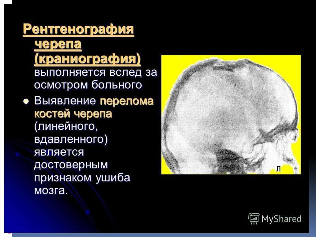 Черепно-мозговые травмы. Классификация, клиника, диагностика и лечение ...