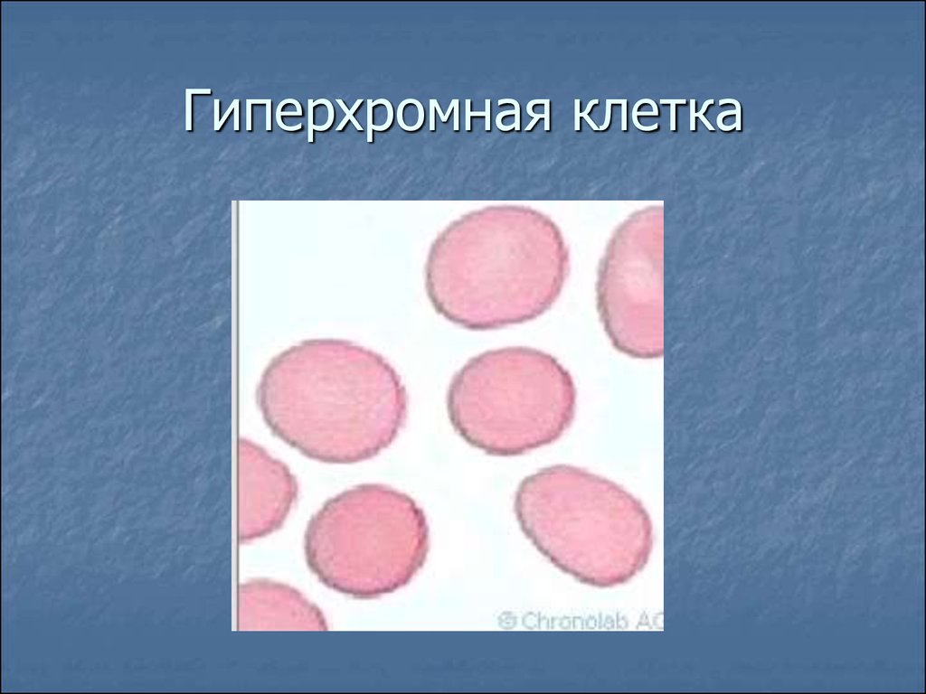 Клетки с гиперхромными ядрами. Гиперхромная анемия. Макроцитарная гиперхромная анемия картина крови. Гиперхромная анемия мазок крови. Гиперхромная макроцитарная анемия микроскоп.