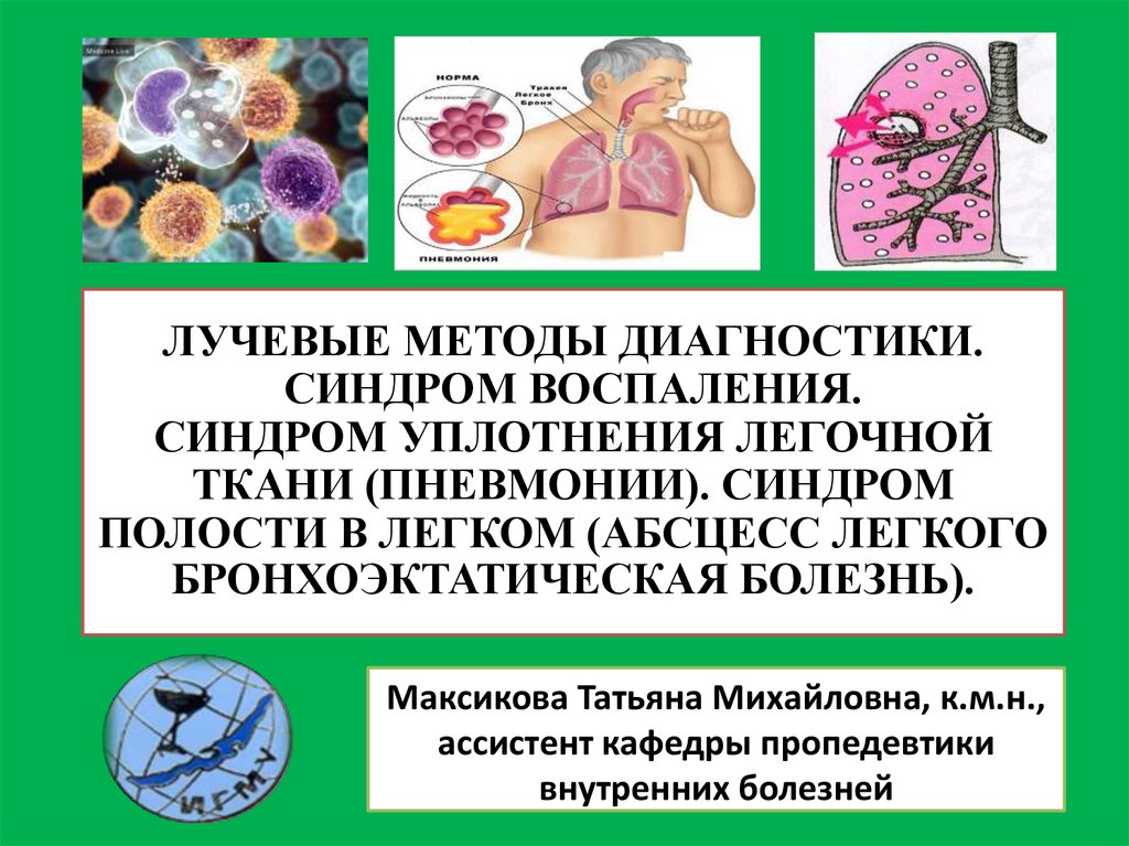 Пневмония синдромы. Синдром уплотнения легочной ткани пропедевтика внутренних болезней. Диагностика синдрома воспалительного уплотнения лёгочной ткани.. Синдром полости в легочной ткани. Лучевая диагностика синдром воспаления.