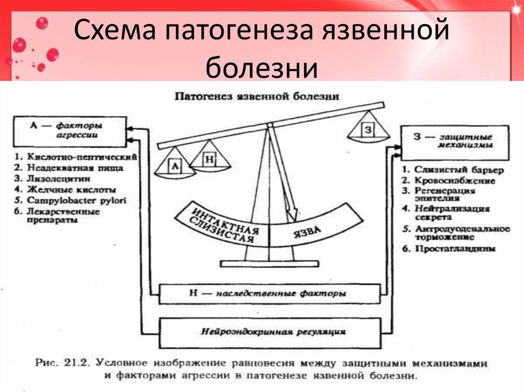 Язвенная болезнь патогенез схема