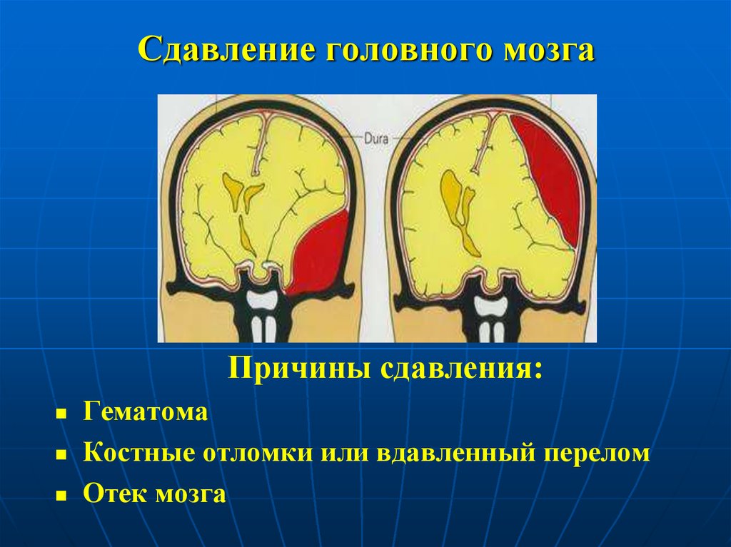 Сдавление головного мозга гематомой. Сдавление головного мозга. Давление головного мозга. Причины сдавления головного мозга.