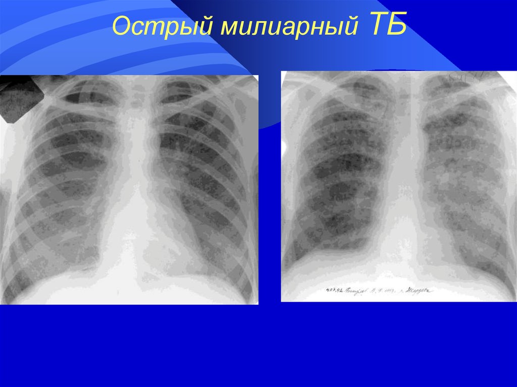 Острый диссеминированный туберкулез. Острый диссеминированный туберкулез рентген. Острый диссеминированный туберкулез легких рентген. Милиарный туберкулез рентген. Милиарный диссеминированный туберкулез.
