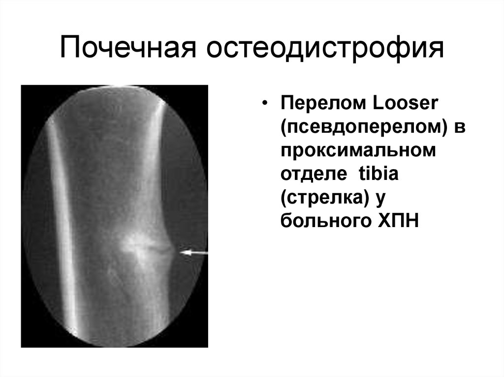 Наследственная остеодистрофия альбрехта презентация