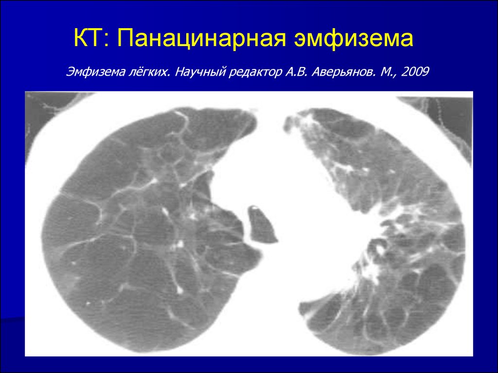 Эмфизема легких презентация