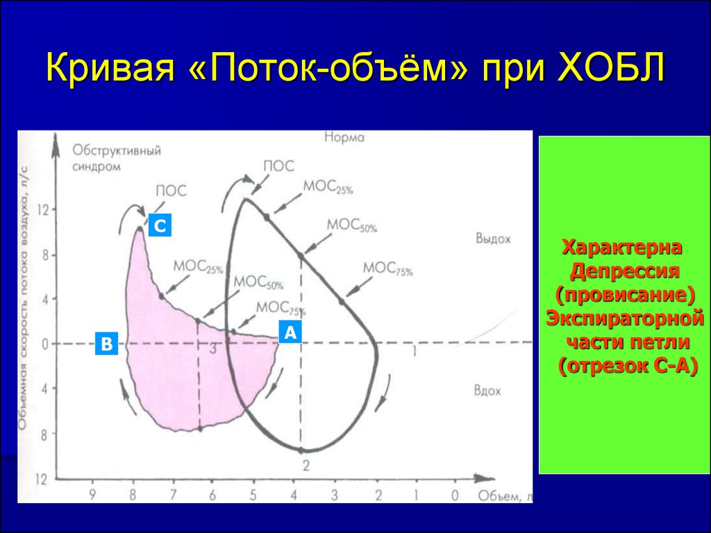 Количество кривой. Кривая поток объем на спирометрии. Кривые поток-объем для различных стадий ХОБЛ.. Спирография петля поток объем. Кривая поток объем на спирометрии заключение.