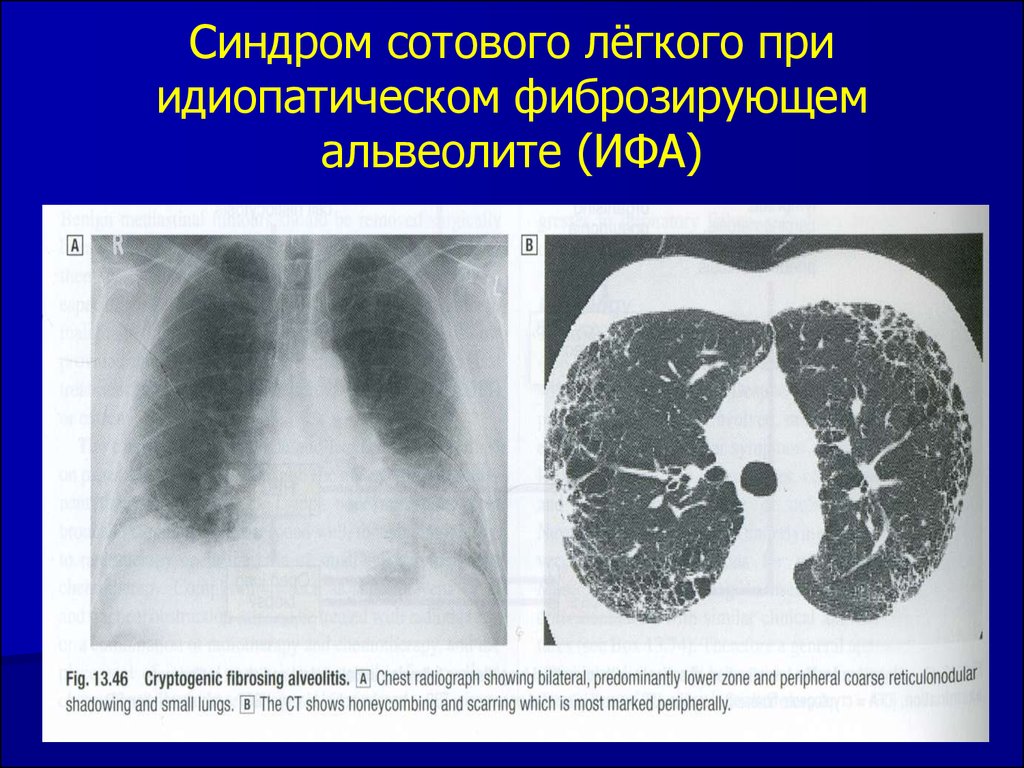 Какая рентгенологическая картина характерна для альвеолитов