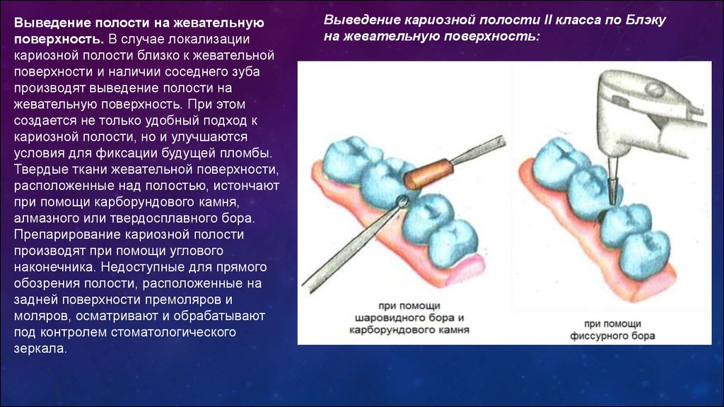 Форма кариозной полости