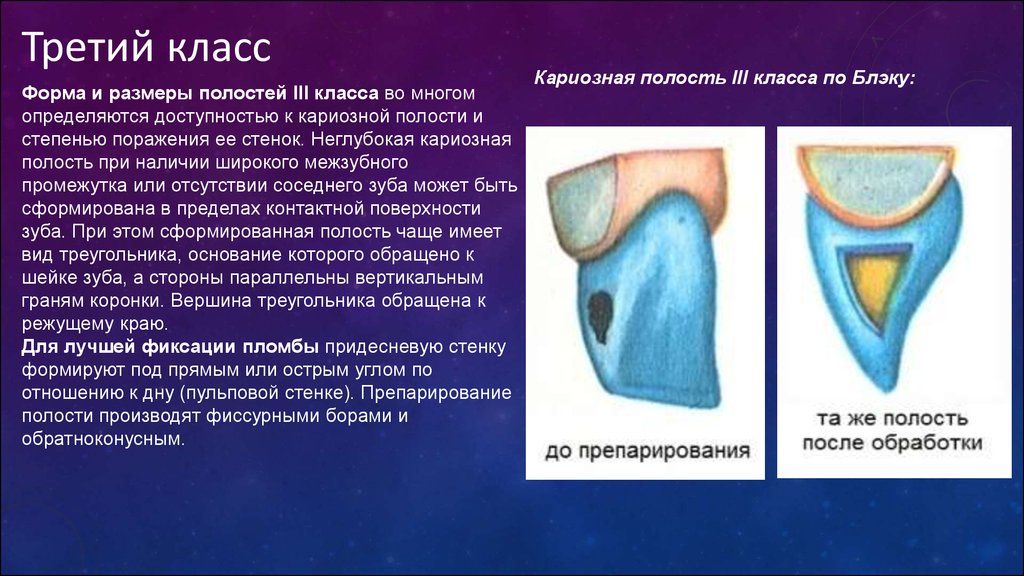 Препарирование кариозных полостей. Последовательность этапов препарирования кариозной полости. Формы кариозных полостей разных классов.