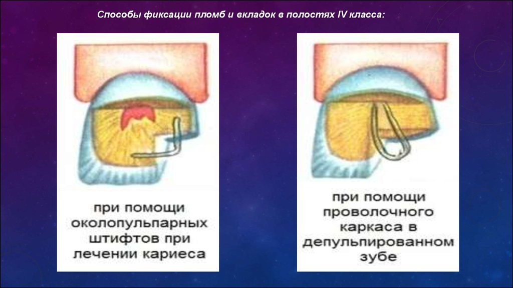 Пломбирование кариозных полостей по блэку. Сэндвич техника пломбирования кариозных полостей. Способы фиксации вкладок. Препарирование кариозных полостей. Кариозная полость, сообщающаяся с полостью зуба.