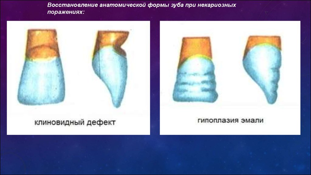 Клиновидный дефект стоматологическая карта