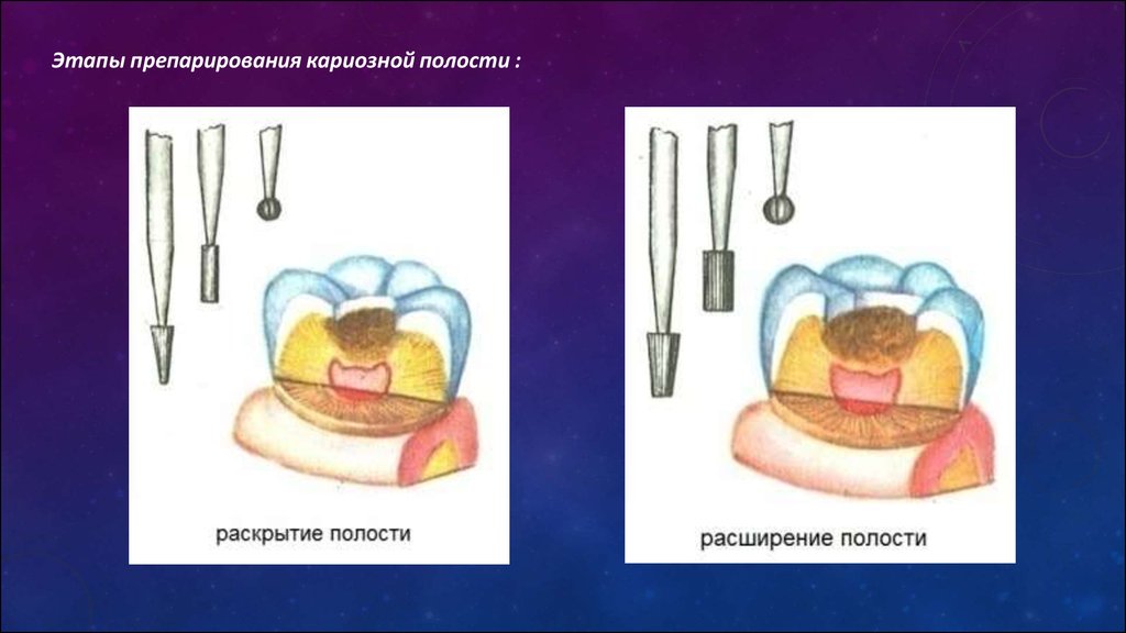 Способы препарирования кариозных полостей