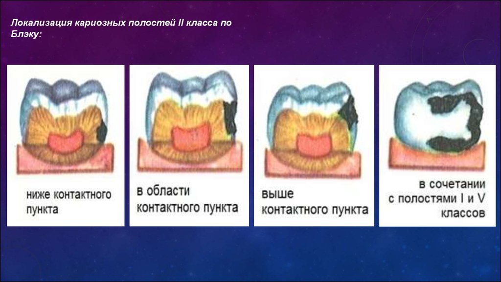 Классификация кариозных полостей по блэку презентация