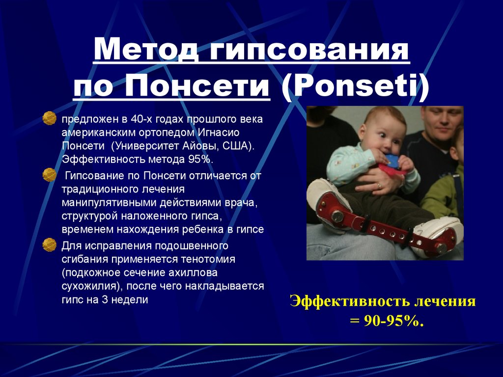 С какого возраста применяют. Метод гипсования Понсети. Гипсование по ме Тоду пансети. Гипсование по методу Понсети. Косолапость гипсование метод Понсети.