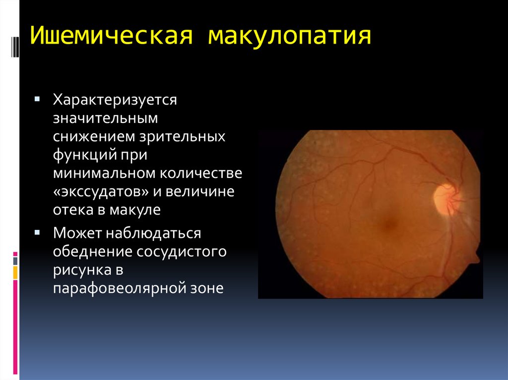 Макулопатия глаза. Диабетическая ишемическая макулопатия. Минимальная макулопатия. Глаза ишемическая макулопатия. Миопическая макулопатия.