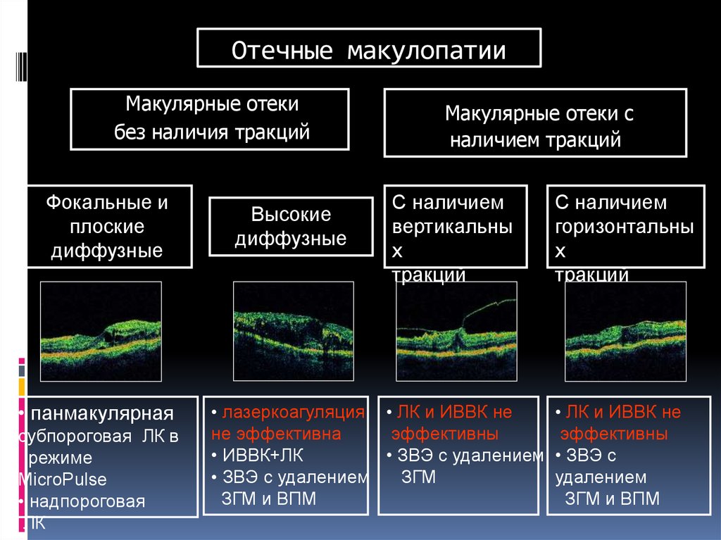 Без наличия. Диабетический макулярный отек классификация. Фокальный макулярный отек. Диабетический макулярный отек окт.