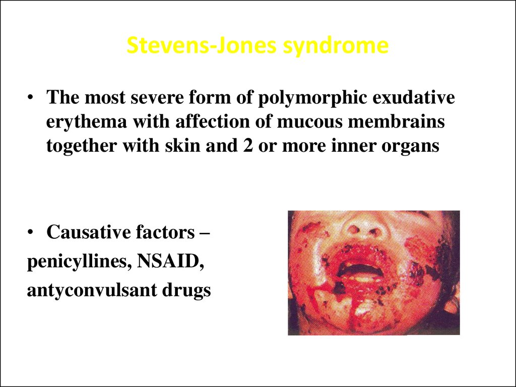 Stevens-Jones syndrome