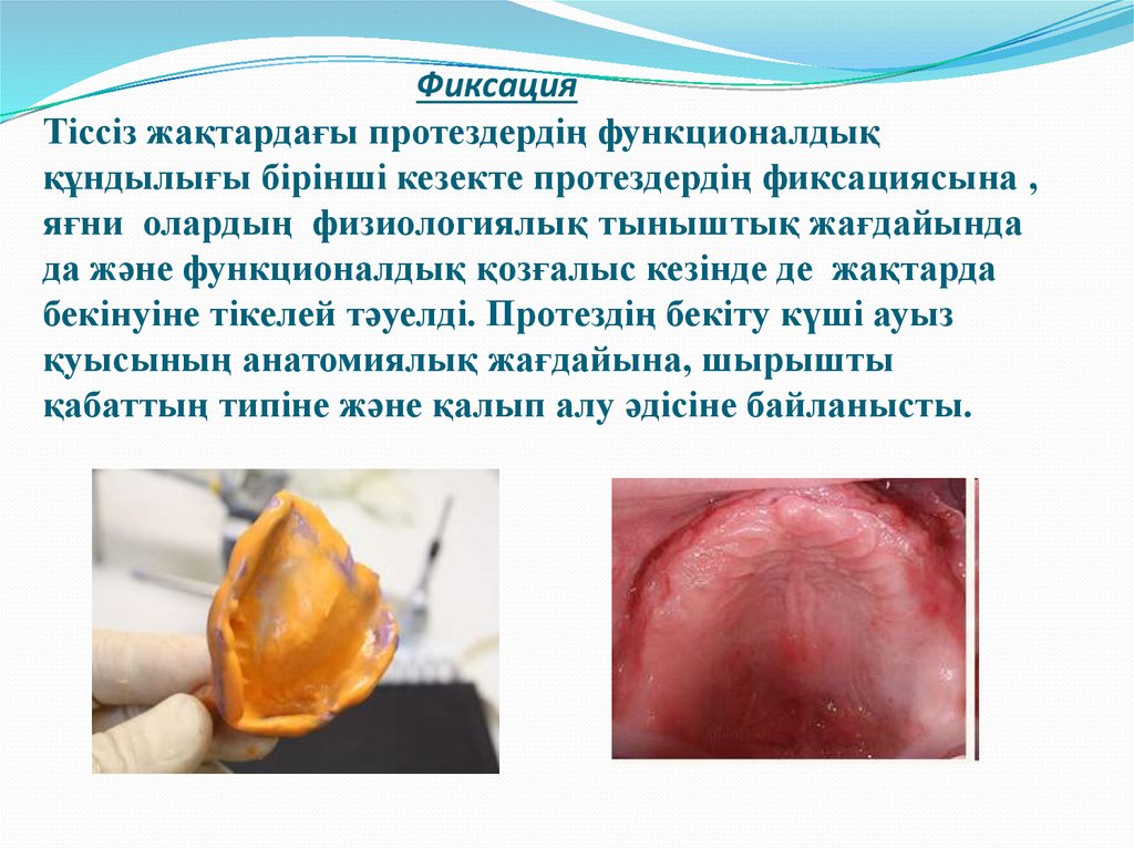 Фиксация Тіссіз жақтардағы протездердің функционалдық құндылығы бірінші кезекте протездердің фиксациясына , яғни олардың