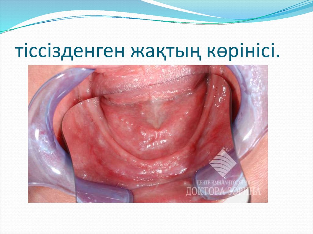 тіссізденген жақтың көрінісі.