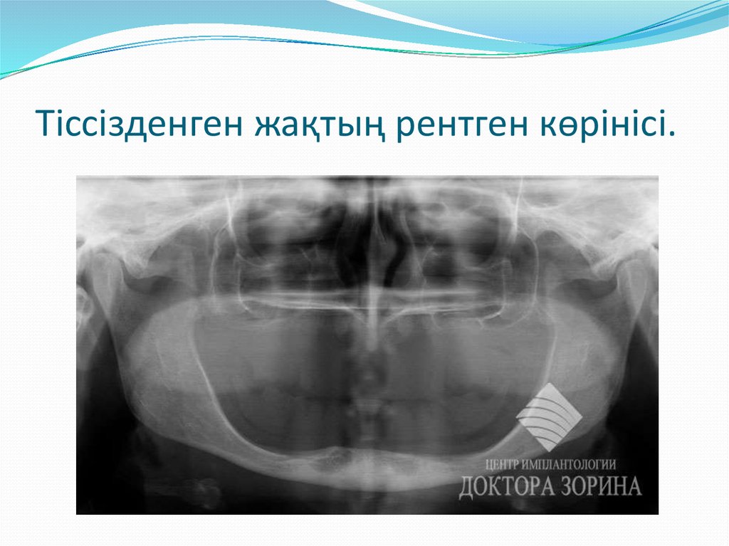Тіссізденген жақтың рентген көрінісі.