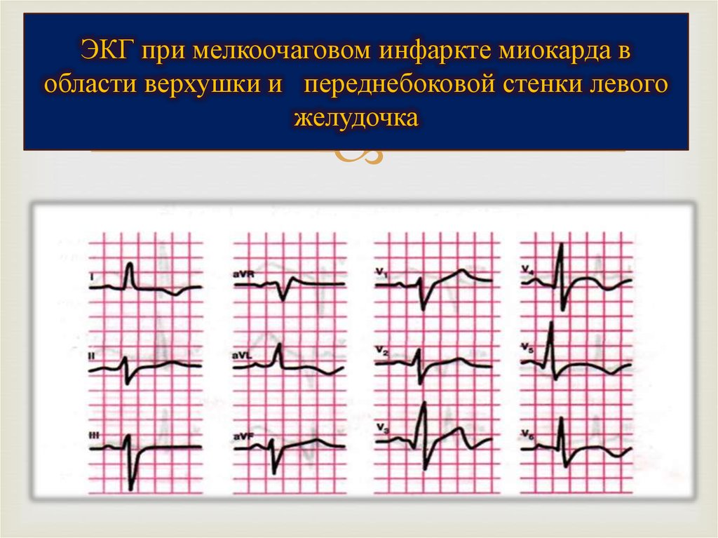 Очаговые изменения левого желудочка. Инфаркт миокарда передней стенки ЭКГ. ЭКГ при инфаркте миокарда левого желудочка. Острый передний инфаркт миокарда на ЭКГ. ЭКГ при инфаркте переднебоковой.