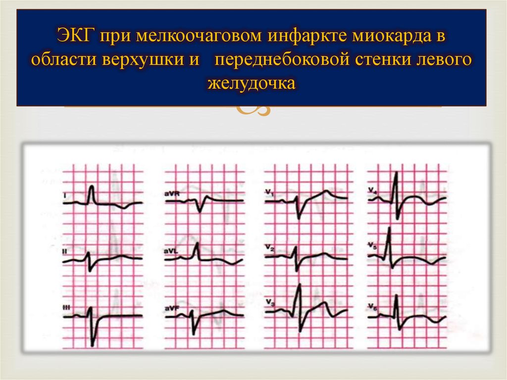 Очаговые изменения левого желудочка