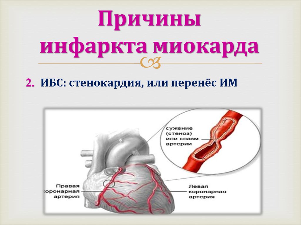 Инфаркт миокарда последствия