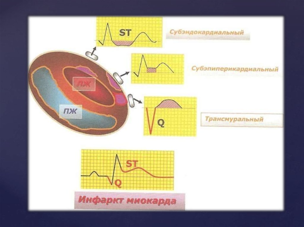 Трансмуральный инфаркт. Трансмуральный инфаркт миокарда на ЭКГ. Мелкоочаговый крупноочаговый трансмуральный инфаркт миокарда на ЭКГ. Субэндокардиальное поражение миокарда ЭКГ. Инфаркт миокарда зоны поражения.