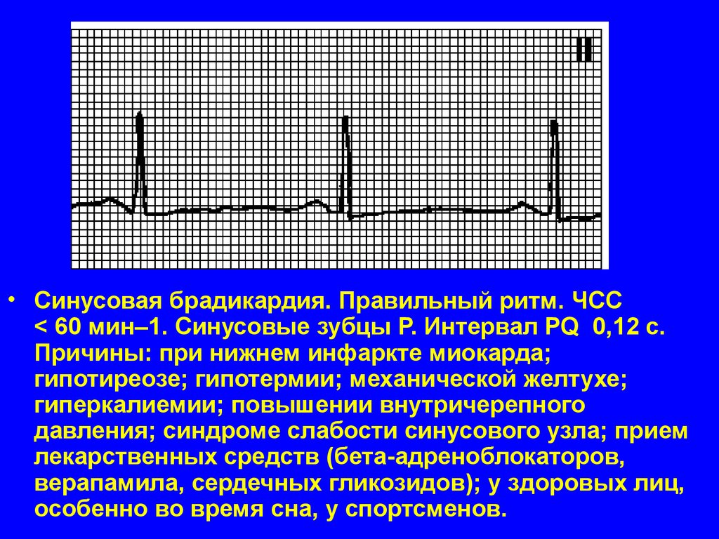 Что такое брадикардия. БПВЛНПГ синусовая брадикардия. Синусовая брадикардия нормы ЧСС. ЧСС при синусовой брадикардии. Синусовая брадикардия клиника.