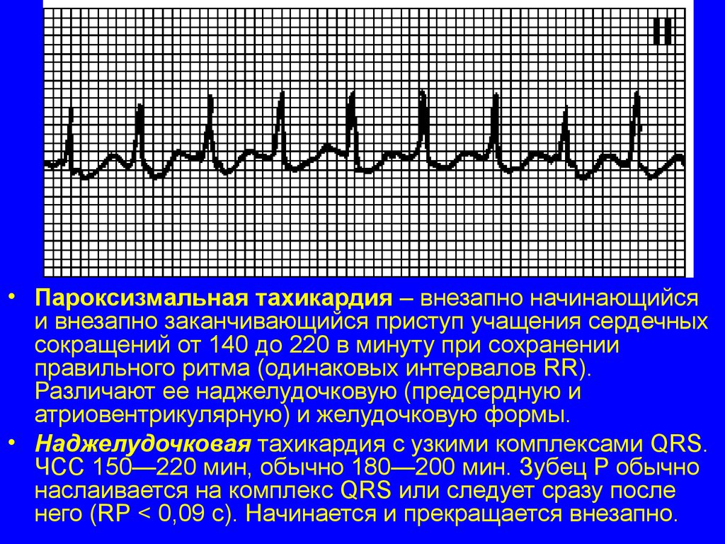 Резко сильное сердцебиение. Синусовая тахикардия ЧСС 140. Параксизмальнаятахикардия. Пароксизмальная тахикардия. Приступ пароксизмальной тахикардии.